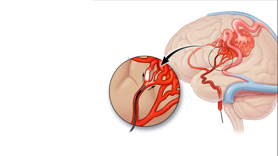 arteriovenous malformation of the brain
