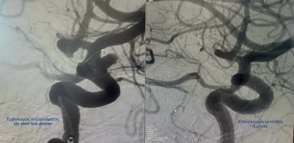stent flow diverter